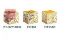 去除脸上黄褐斑有哪些方法？成好吗？
