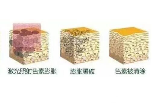 去除脸上黄褐斑