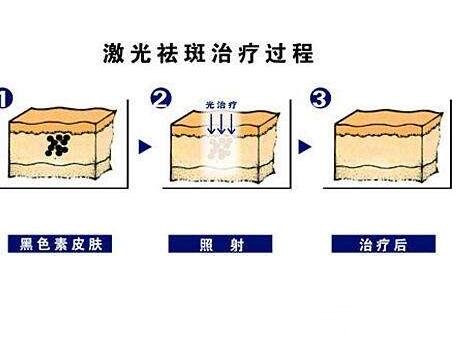 去除脸上黄褐斑