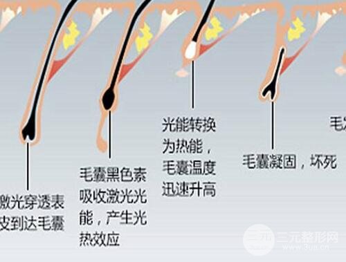怎样才能长时间性脱毛