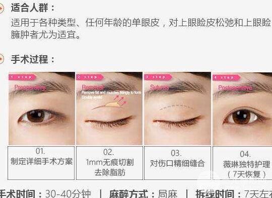 北京割双眼皮多少钱