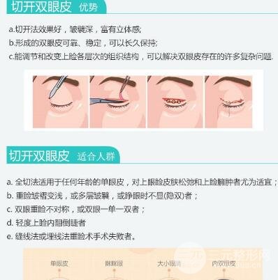 北京割双眼皮多少钱