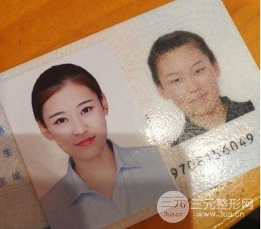 激光双眼皮手术
