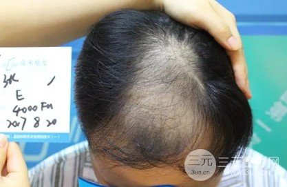 秃顶能植发吗