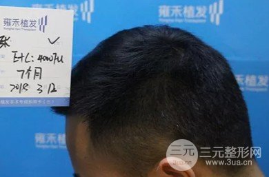 秃顶能植发吗
