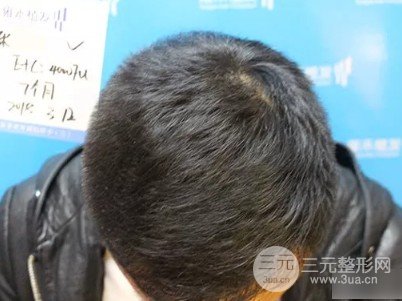 秃顶能植发吗
