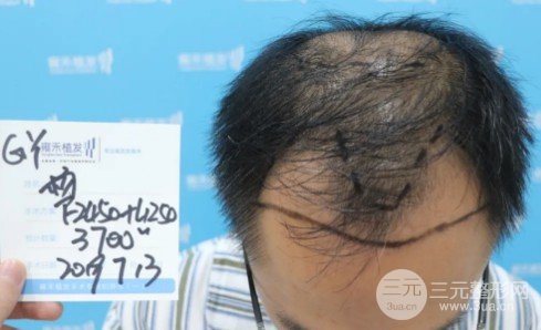 秃顶能植发吗