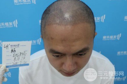 秃顶能植发吗