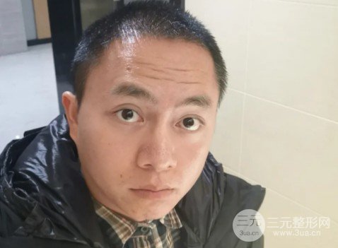秃顶能植发吗
