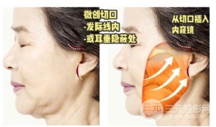 大拉皮小拉皮手术对比