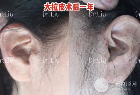 大拉皮小拉皮手术对比