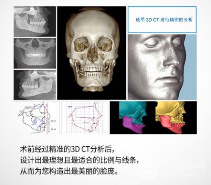脸部轮廓整形多少钱
