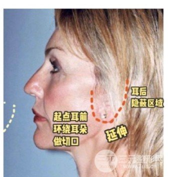 大拉皮手术少钱
