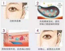 打注射瘦脸多久能看到果？真实的注射瘦脸照片比较