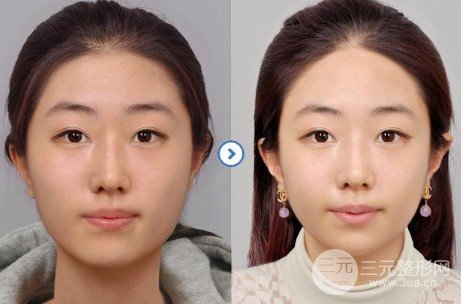 打注射瘦脸多久能看到果