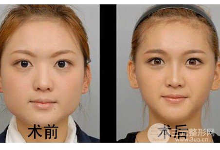 打注射瘦脸多久能看到果