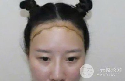 河南植发正规医院收费标准