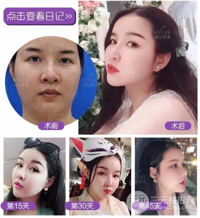 怎样消除双下巴