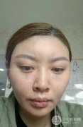 面部除皱一到三天变化图：变年轻只需几天？