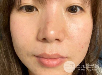 光子嫩肤祛痘印果