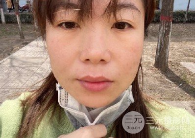 光子嫩肤祛痘印果