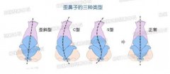 鼻子歪了如何矫正?隆鼻后歪了如何修复? 鼻子歪了如何矫正?隆鼻后歪了如何修复?