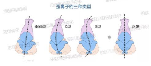 鼻子歪了如何矫正