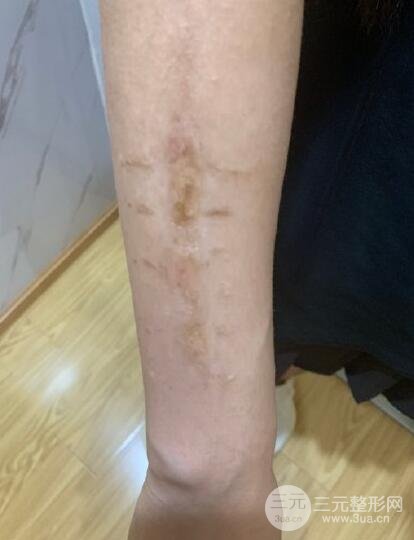 湖南省人民医院谭军医生疤痕修复案例分享!90天后终于放心露肤啦!