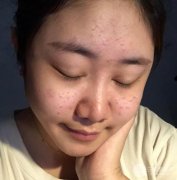 果酸换肤果对照：告别痘肌后颜值蹭蹭上涨！