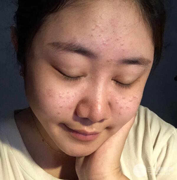 果酸换肤果对照：告别痘肌后颜值蹭蹭上涨！