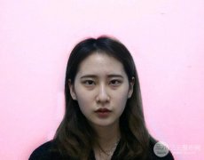 眼袋填充泪沟前后对比：人瞬间年轻了好几岁！