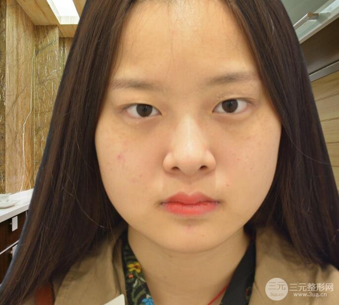 双眼皮手术之前