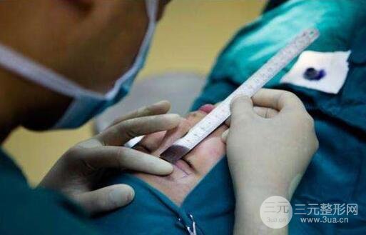 双眼皮10天图片:双眼皮恢复速度称奇!