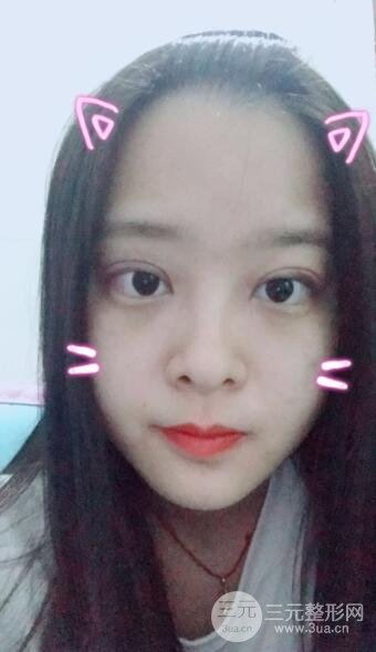 双眼皮手术之后的恢复过程