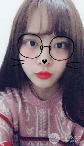 双眼皮手术之后的恢复过程