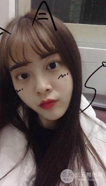 双眼皮手术之后的恢复过程