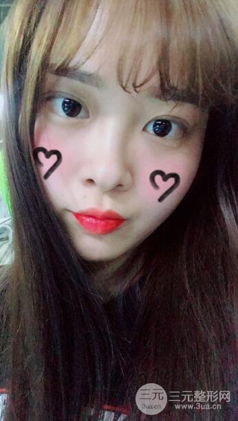双眼皮手术之后的恢复过程