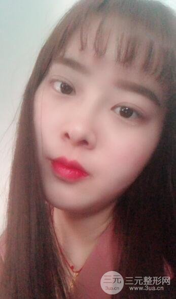 双眼皮手术后1-3个月