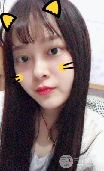 双眼皮手术后1-3个月