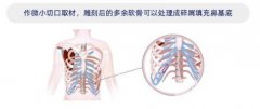 自体隆鼻价格多少?隆鼻后鼻子可以揉捏吗? 自体隆鼻价格多少?隆鼻后鼻子可以揉捏吗?