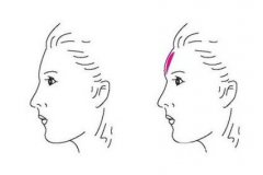 额头整形术前后图片，正规的3种丰额头整形方式