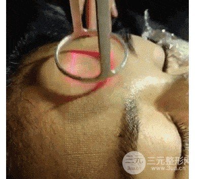 去除痘印疤痕方法