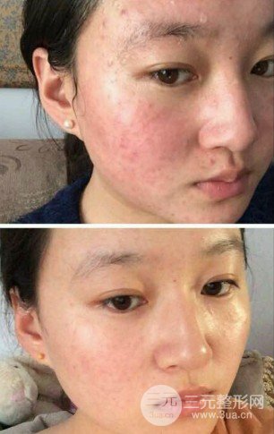 去除痘印疤痕方法