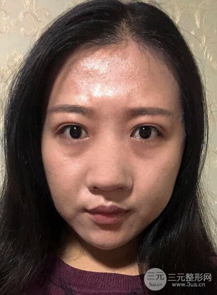 玻尿酸隆鼻前