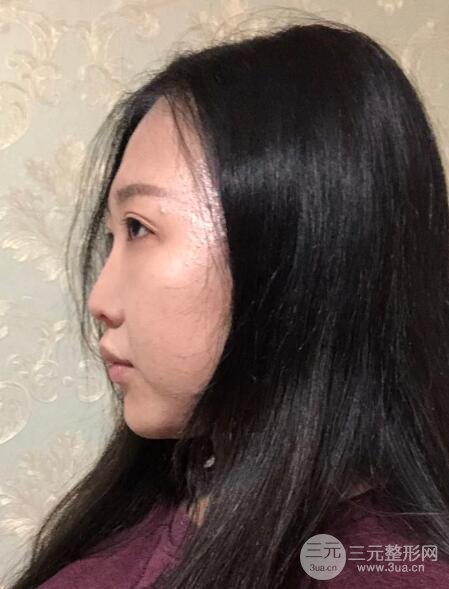 玻尿酸隆鼻前