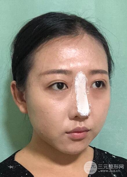 玻尿酸隆鼻手术的恢复过程