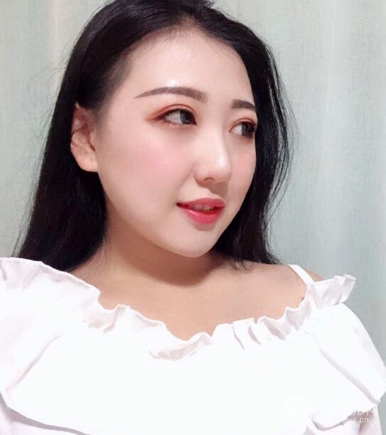 玻尿酸隆鼻手术的恢复过程