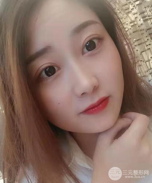 湘雅医院龙剑虹好吗医生口碑评价医生双眼皮案例