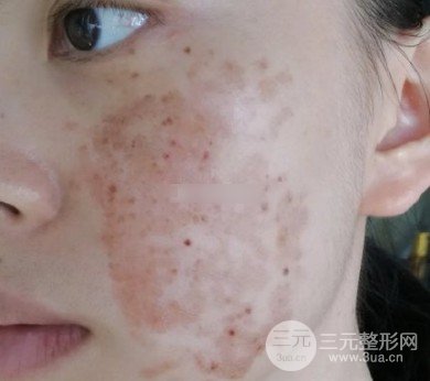光子嫩肤注意事项