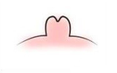 乳头内陷矫正手术